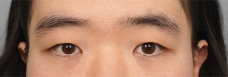 수술전