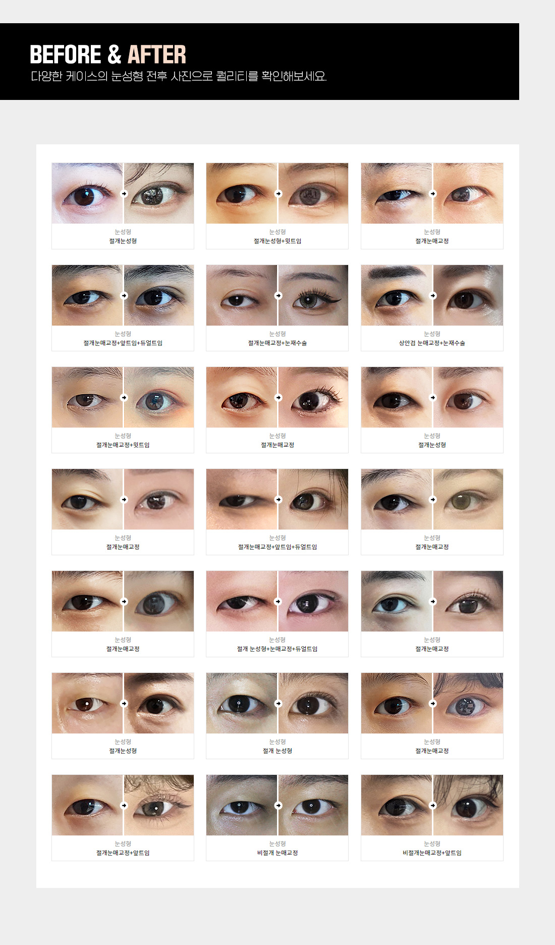 눈성형전후사진