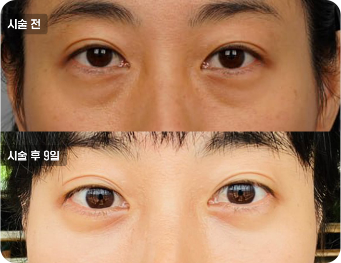 코성형수술전후사진