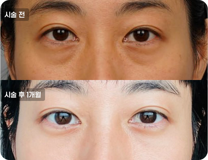 코성형수술전후사진