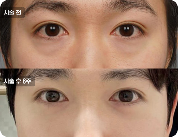 코성형수술전후사진