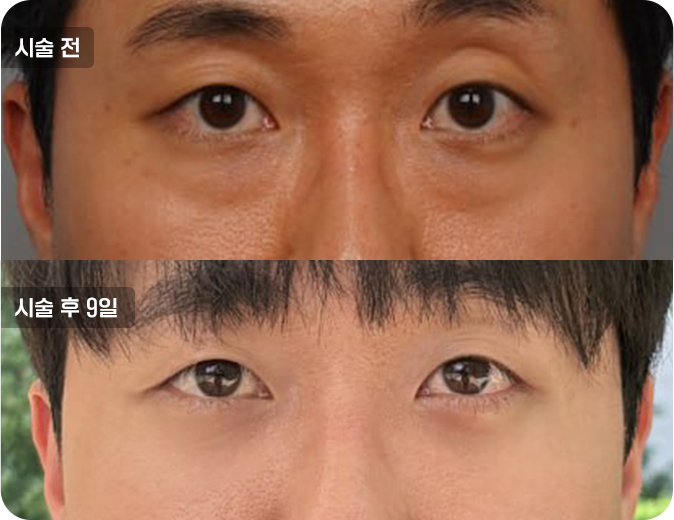 코성형수술전후사진