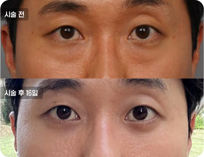 코성형수술전후사진