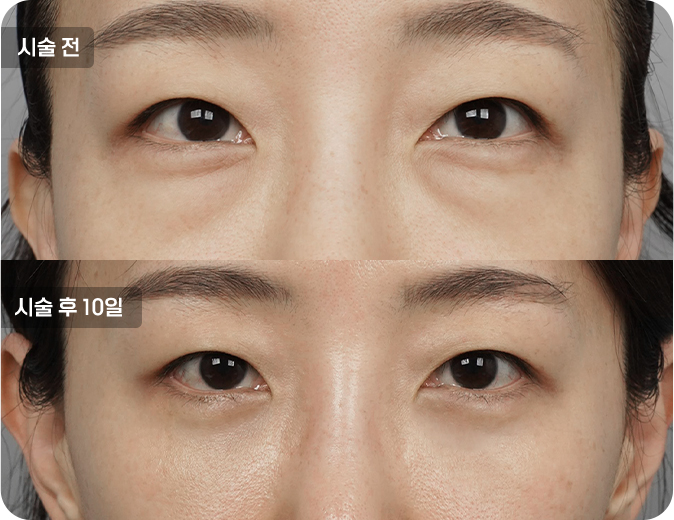 코성형수술전후사진