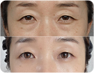 앙코르눈밑지수술전후사진