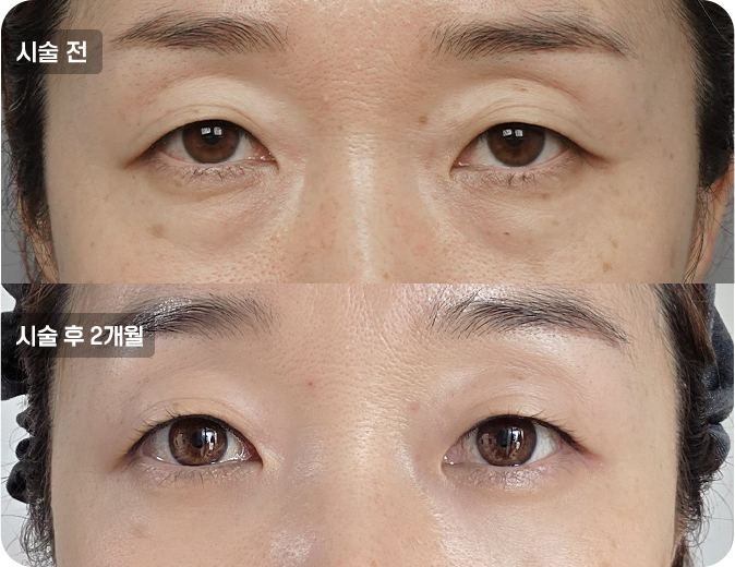 코성형수술전후사진