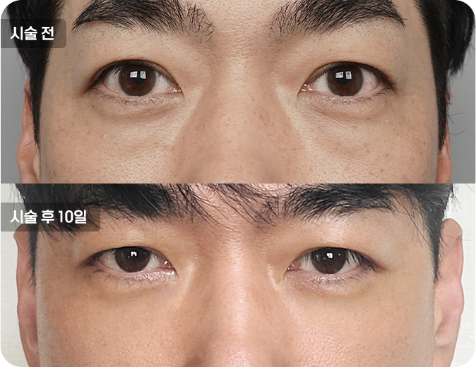 코성형수술전후사진