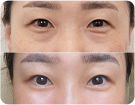 앙코르눈밑지수술전후사진