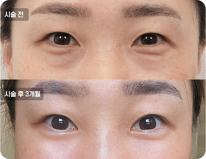 코성형수술전후사진