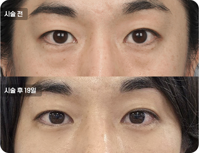 코성형수술전후사진