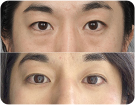 앙코르눈밑지수술전후사진