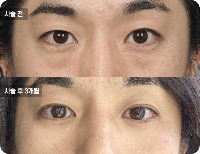 코성형수술전후사진