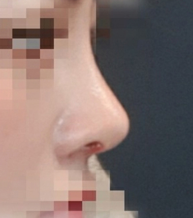 콧대, 코끝 한달 후