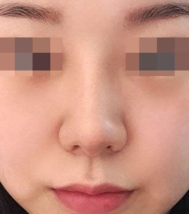 개방코성형 2주 후