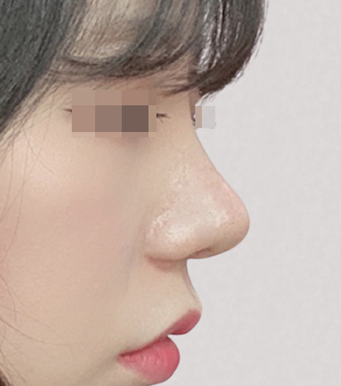 개방코성형 2주 후