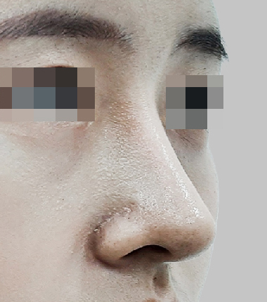 개방코성형+매부리 7개월 후