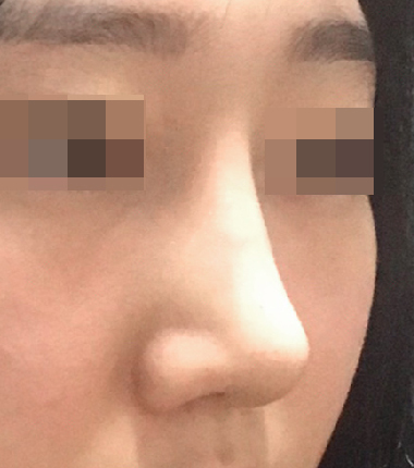 개방코성형 6개월 후
