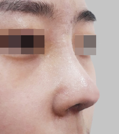 개방코성형 7일 후