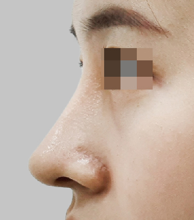 매부리코성형 7개월 후