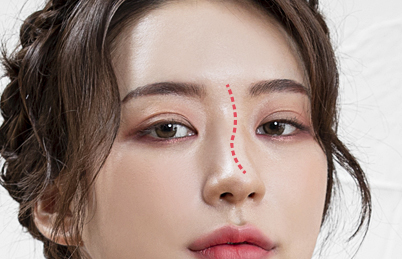 보형물이이동한경우
