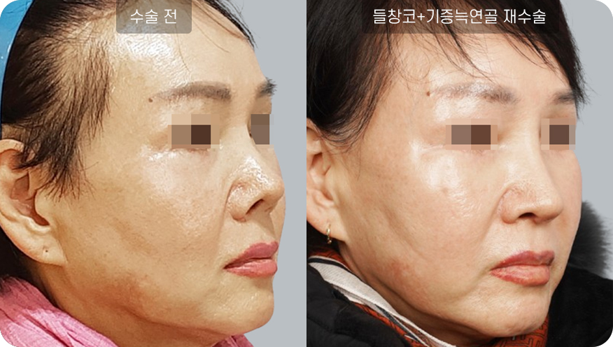 코성형수술전후사진