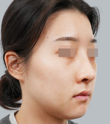 개방코성형+3D맞춤보형물+자가늑연골 2주 후