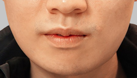 광대, 사각턱축소 한달 후