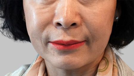 안면거상 2주 후