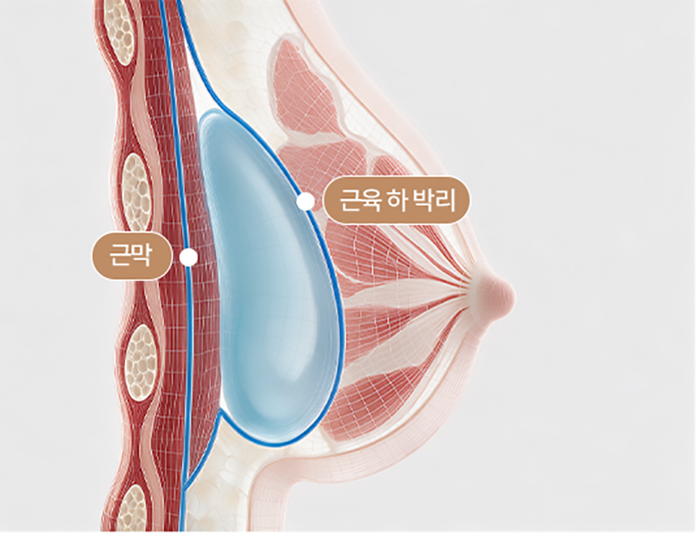 근막하 삽입 수술법