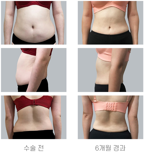 수술 후 6개월