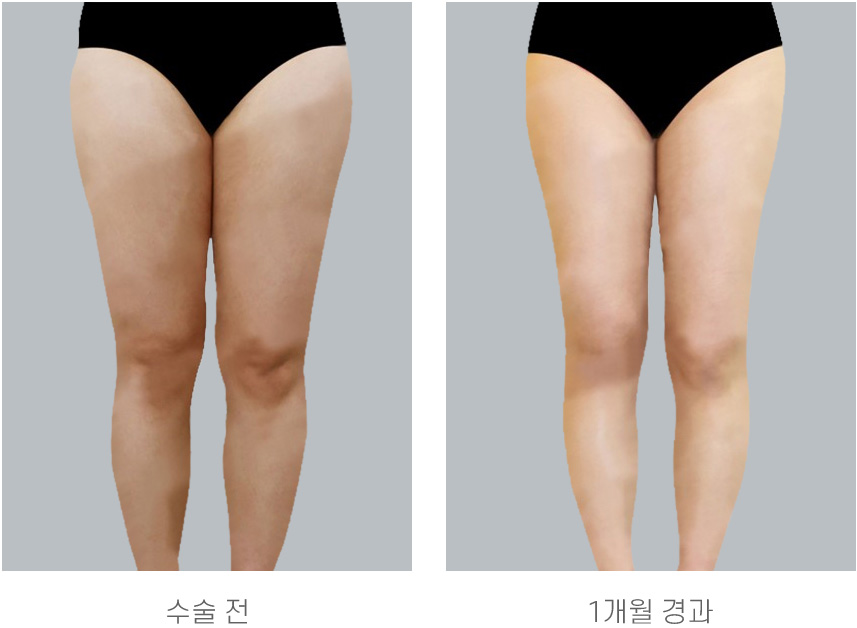 수술 후 1개월