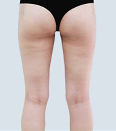허벅지흡입 한달 후