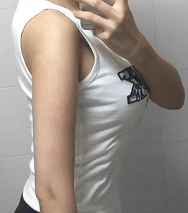 팔뚝흡입 3주 후