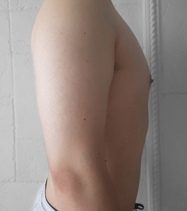 복부흡입 6주 후