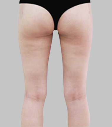 허벅지흡입 한달 후