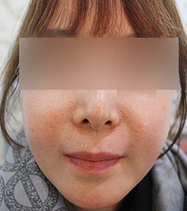 얼굴지방이식 2주 후