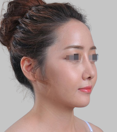 얼굴지방이식 2주 후