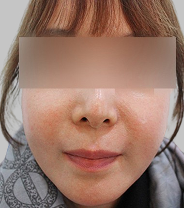 얼굴지방이식 2주 후