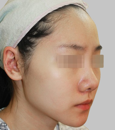 이마지방이식 2주 후