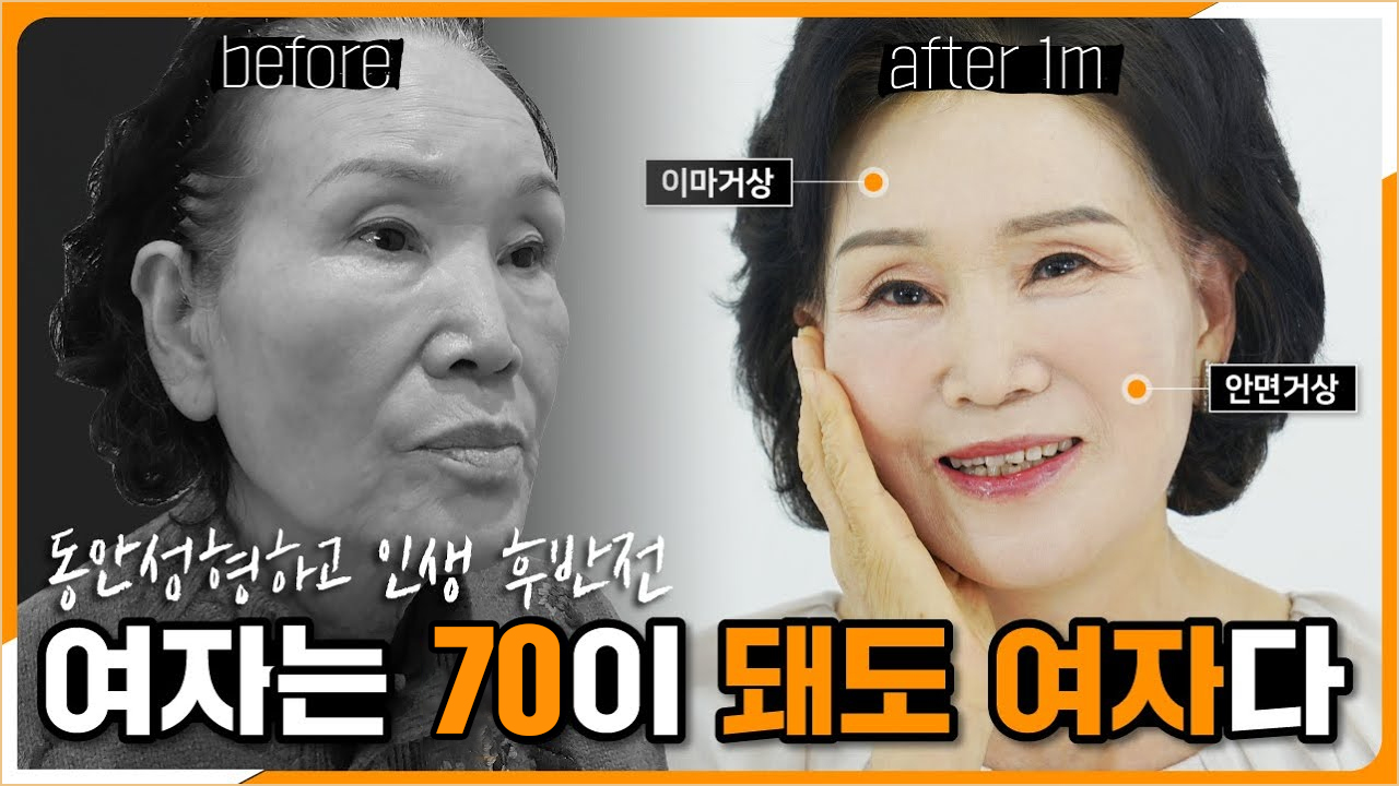 한나이브커스텀안면거상