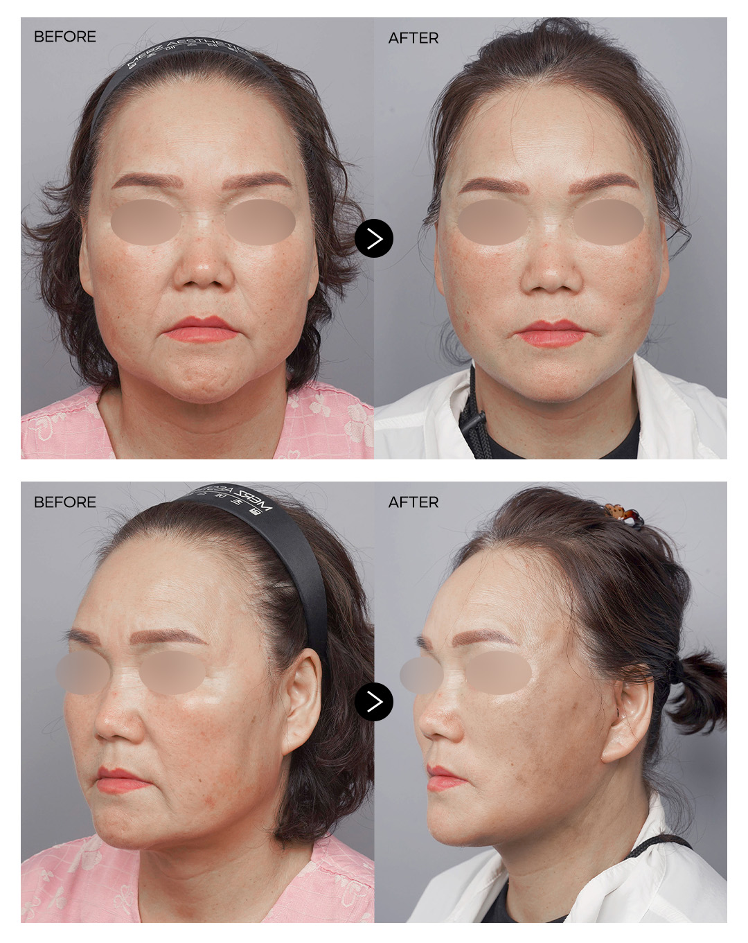 안면거상+하안검 전후