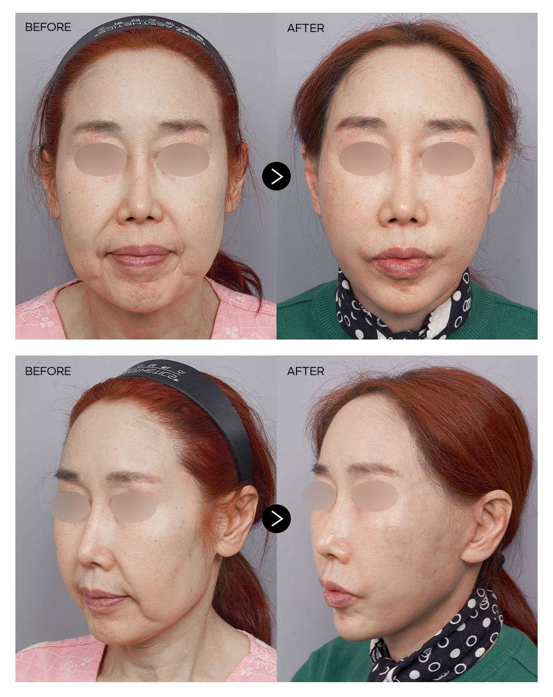 안면거상+하안검+목리프팅 전후