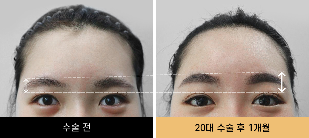 내시경이마거상