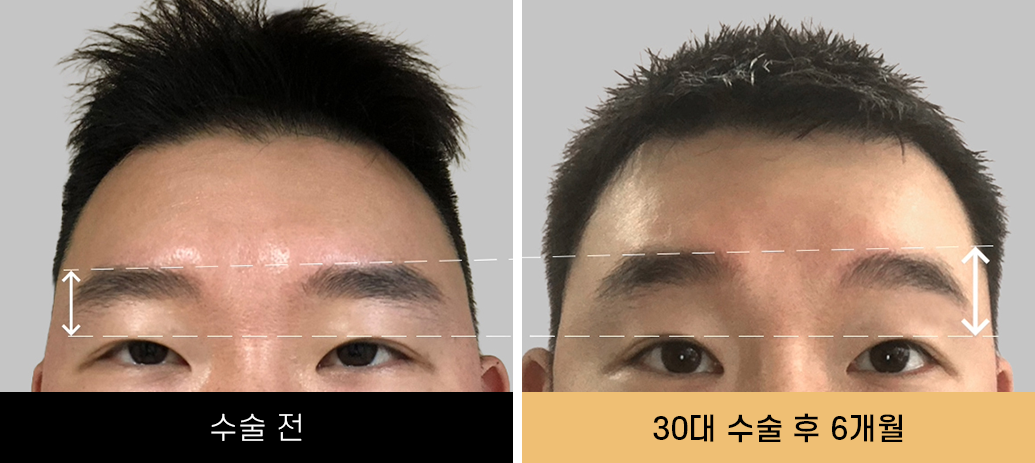 내시경이마거상