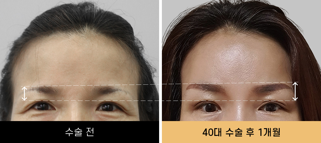 내시경이마거상