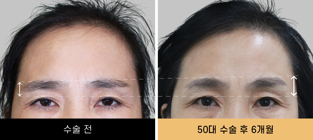 내시경이마거상