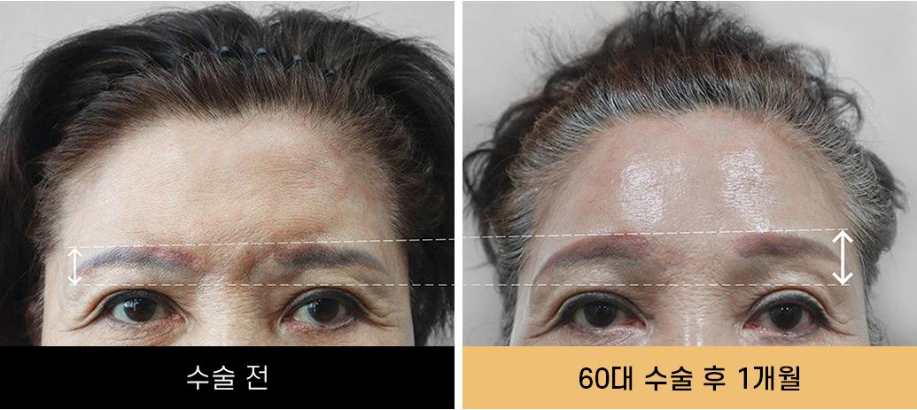 내시경이마거상