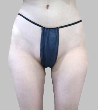 시술전