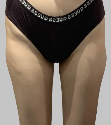 시술전