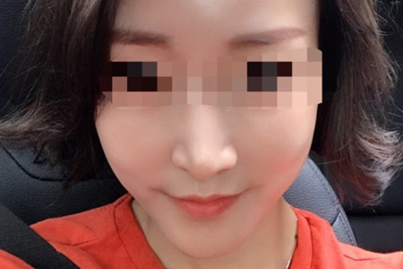 샤넬주사 2주 후
